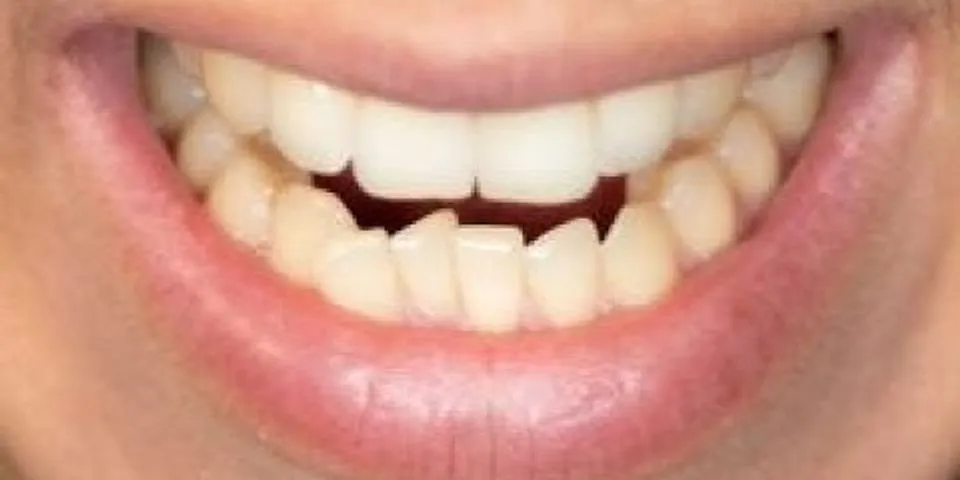 What is it called when your teeth are slanted?